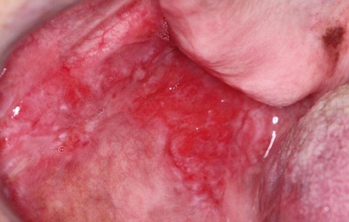 زخم غیر عادی در دهان