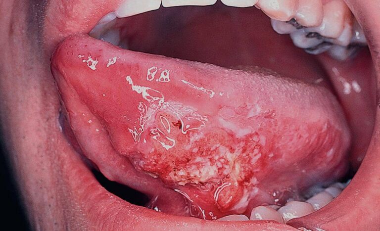 زخم زیر زبان