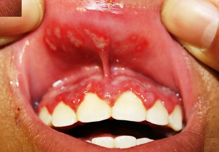 تبخال دهانی