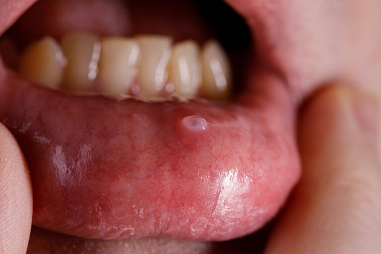 Oral Mucocele
