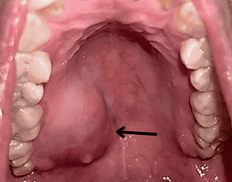 آدنوم پلئومورفیک