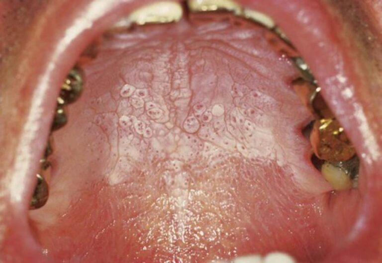 استوماتیت نیکوتینی