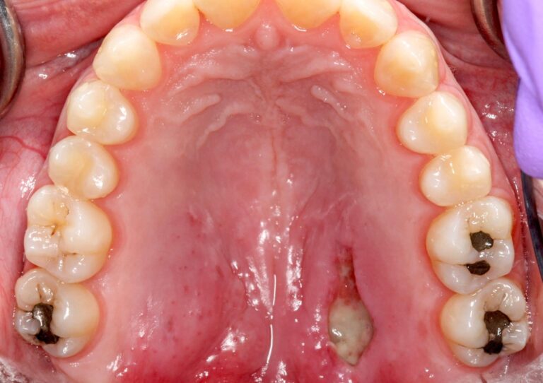 سیالومتاپلازی نکروزان