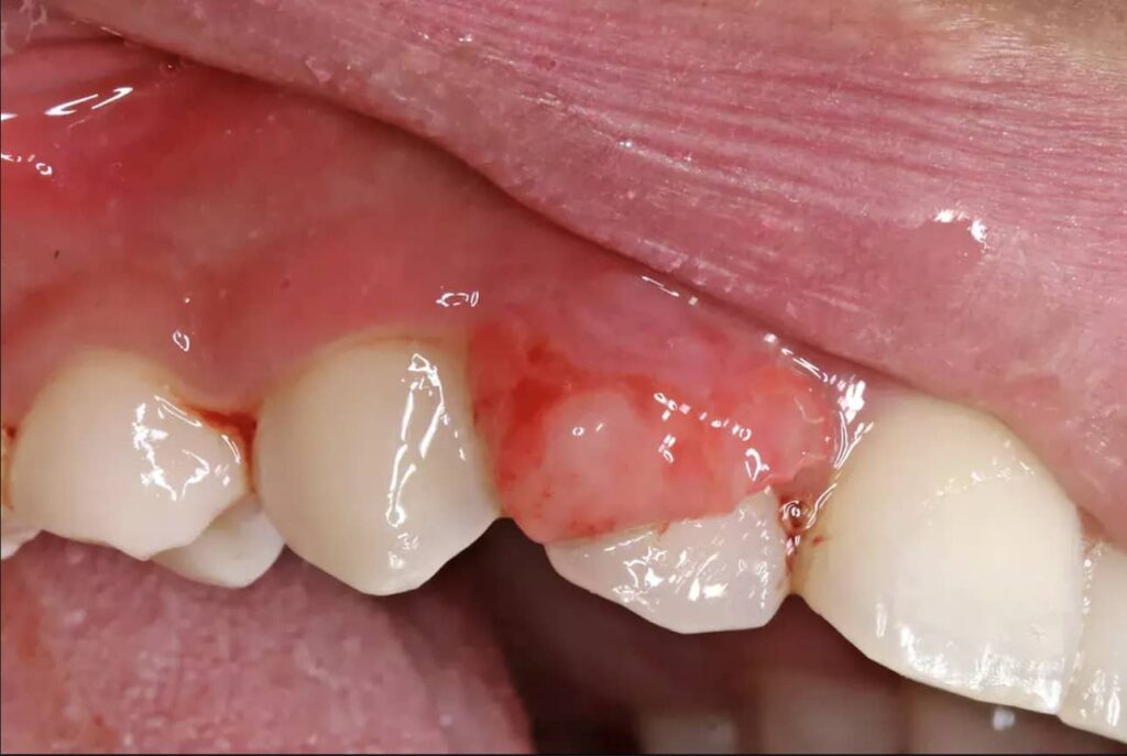 عکس زخم روی لثه