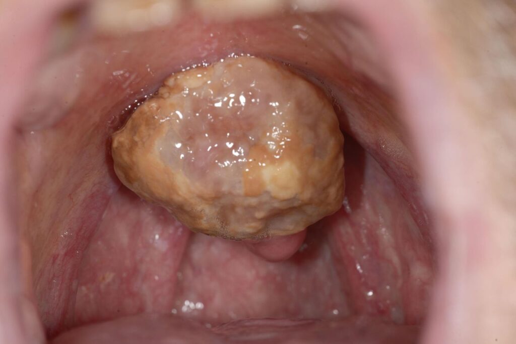 عکس سرطان سقف سخت دهان