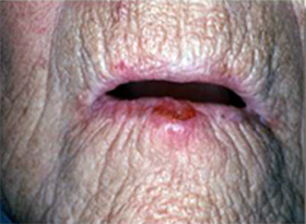 عکس کارسینوم سلول سنگفرشی