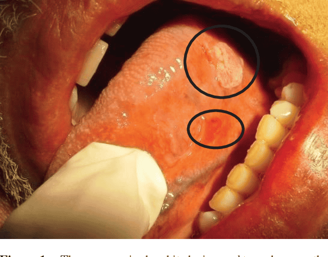 لکه های سفید و قرمز دهان