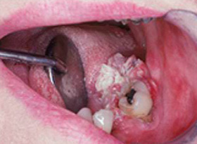 وروکوس کارسینوما