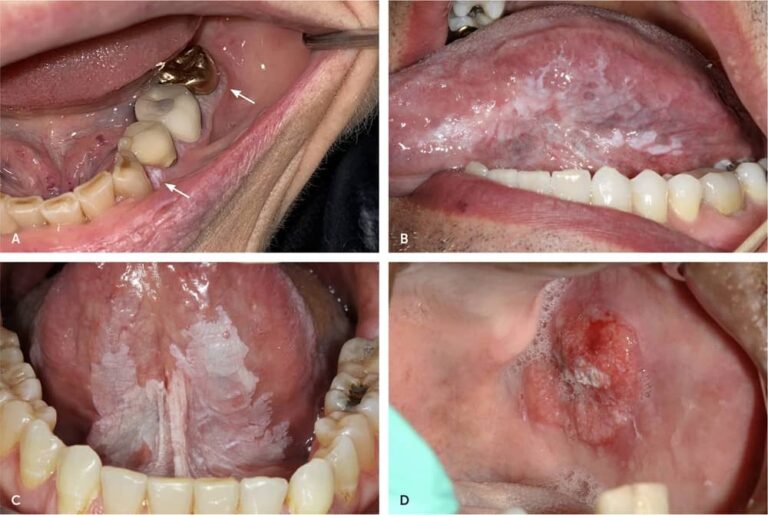 کارسینوم سلول سنگفرشی