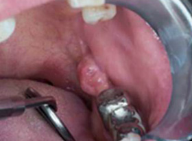 کارسینوم سلول سنگفرشی  نوع گره‌دار