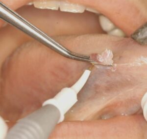 درمان زگیل دهانی