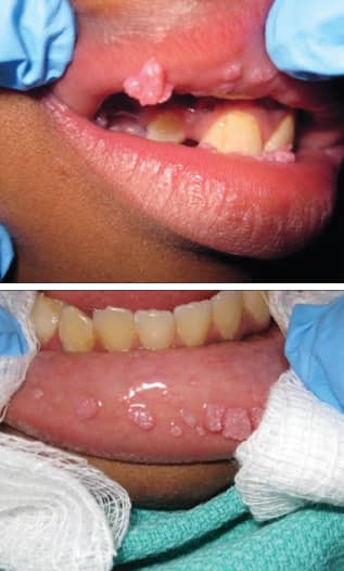 oral warts