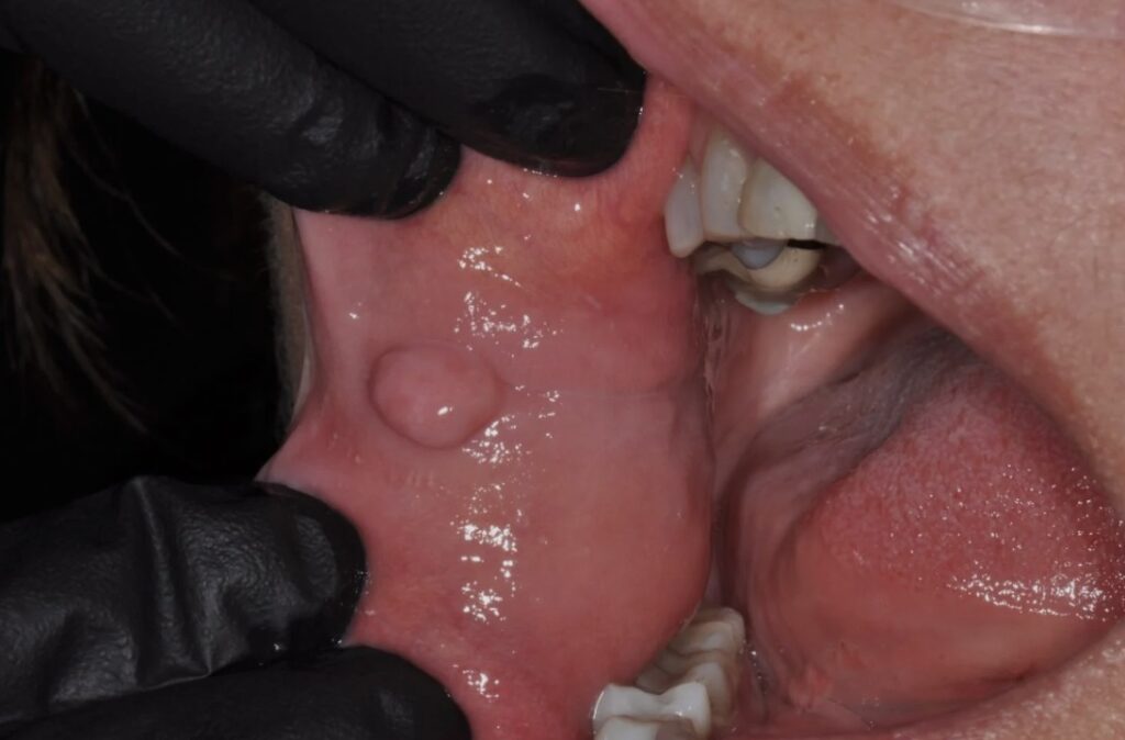 گوشت اضافه در دهان