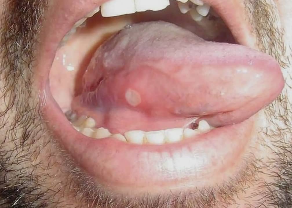 آفت زیر زبانی