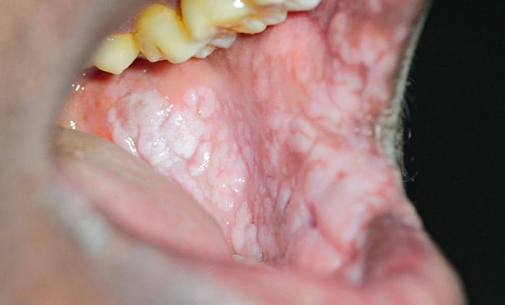 زگیل در سقف دهان