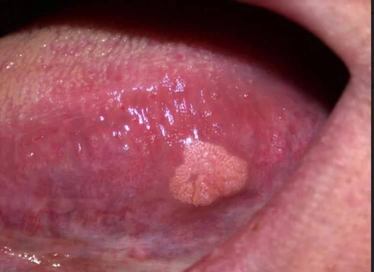 زگیل زبان عکس