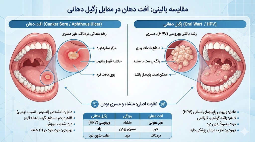 تفاوت آفت دهان با زگیل دهانی