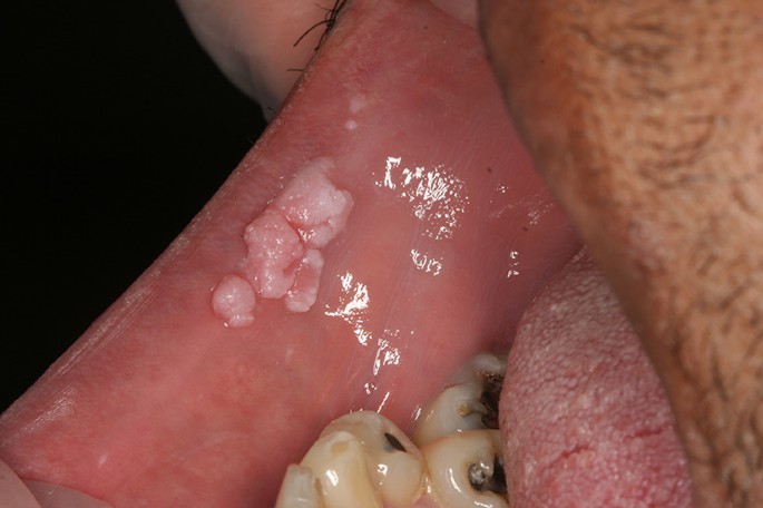 تصویر زگیل تناسلی در دهان