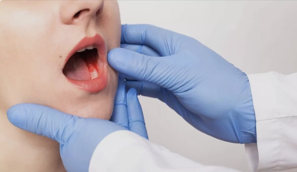 درمان سرطان دهان